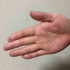 手荒れだと思っていたら まさかの 手の水虫 手荒れ対策のおすすめと実際に試してみた対策レポート 手荒れだと思っていたら まさかの 手の水虫 手荒れ対策のおすすめと実際に試してみた対策レポート