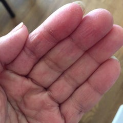 手の指の皮がむける 治療 体験記 指の皮がむける 刺激性接触性皮膚炎
