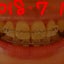 画像 歯列矯正記録〜インビザラインから抜歯ブラケット矯正へのユーザープロフィール画像