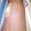 20代で変形性膝関節症!?のサムネイル
