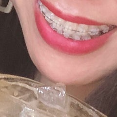 本当の横顔 口元のでっぱりがコンプレックス 35歳からの歯列矯正 本当の横顔 口元のでっぱりがコンプレックス 35歳からの歯列矯正